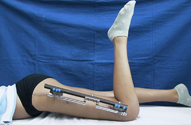 Limb Lengthening Surgeon in Faridabad