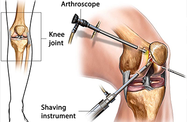 Knee Arthroscopic Surgery