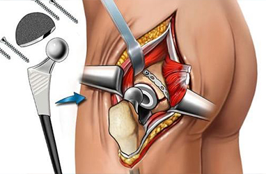 Hip Replacement Surgeon